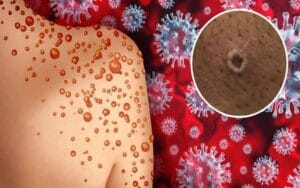 Central government alert regarding monkeypox, these instructions given for prevention...