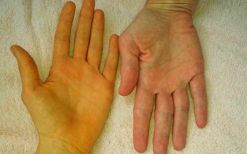 पीलिया को लेकर स्वास्थ्य विभाग अलर्ट, अब तक सामने आए…