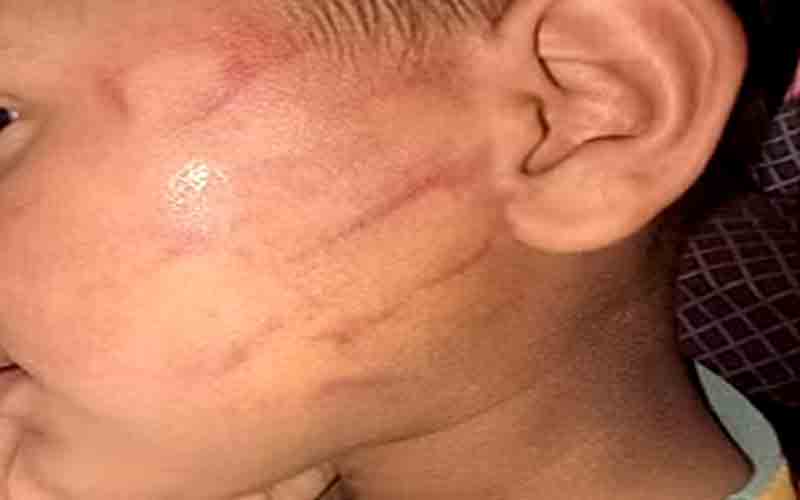अध्यापक ने की तीसरी कक्षा के छात्र की निर्मम पिटाई