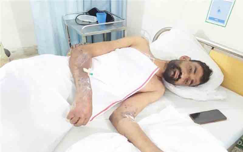 लौह उद्योग में चार कामगारों पर गिरा गर्म लोहा, अस्पताल में भर्ती