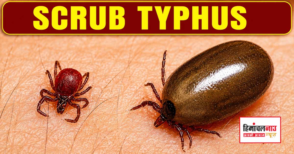Scrub Typhus / हिमाचल में स्क्रब टायफस के संदिग्ध मामले बढ़े, आईजीएमसी में पांच मरीज भर्ती, जांच जारी